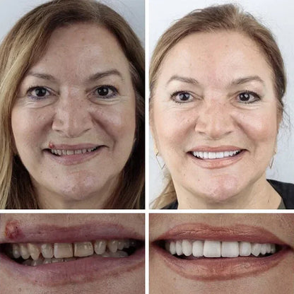 Ends Today: 70% OFF! ⏰ KLENIMORE™ Custom-Fit Smile Support Set — Strong Hold & Natural Look 🦷