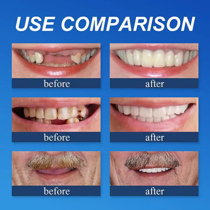 Ends Today: 70% OFF! ⏰ KLENIMORE™ Custom-Fit Smile Support Set — Strong Hold & Natural Look 🦷